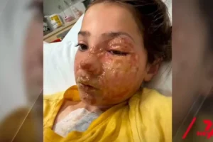 Menina de 10 anos sofre queimaduras no rosto após fazer desafio do TikTok