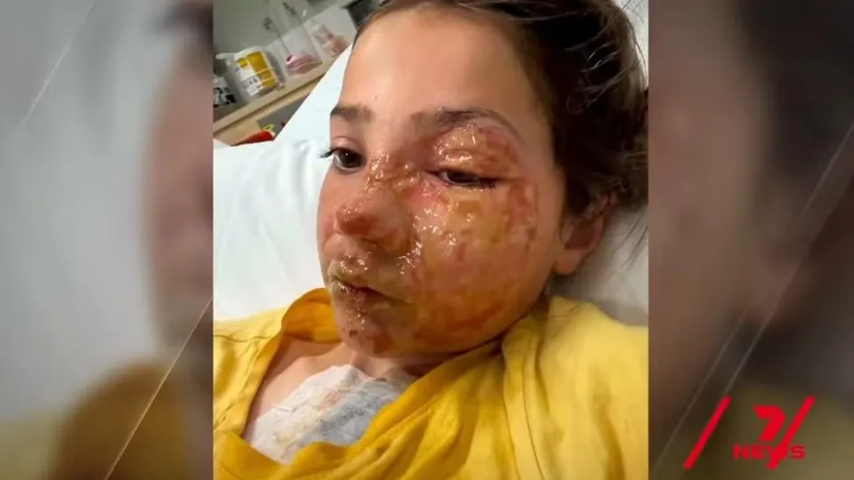 Menina de 10 anos sofre queimaduras no rosto após fazer desafio do TikTok